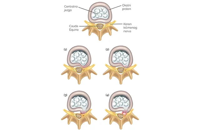 Diskus hernija