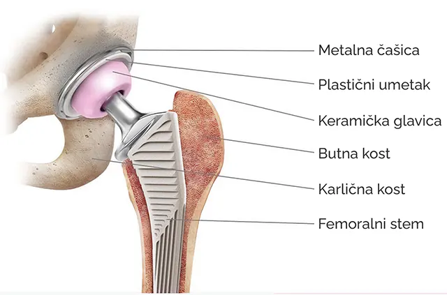 Veštački kuk (totalna aloartroplastika kuka) Veštački kuk – totalna aloartroplastika kuka