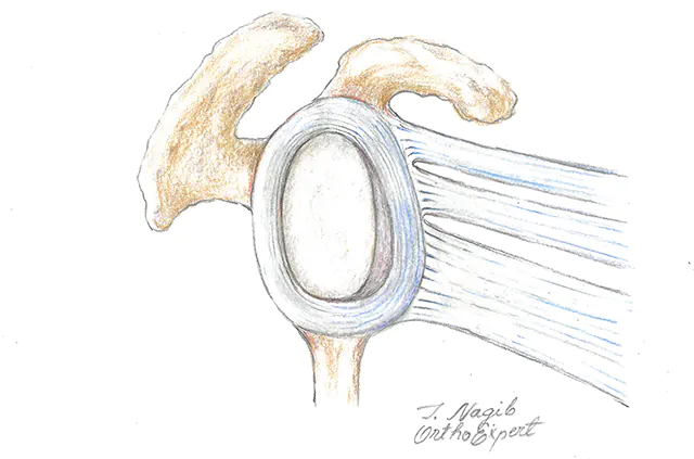 Bankart lezija – otrgnut ligament ramena