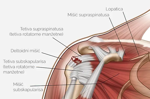 Raskid tetive rotatorne manžetne