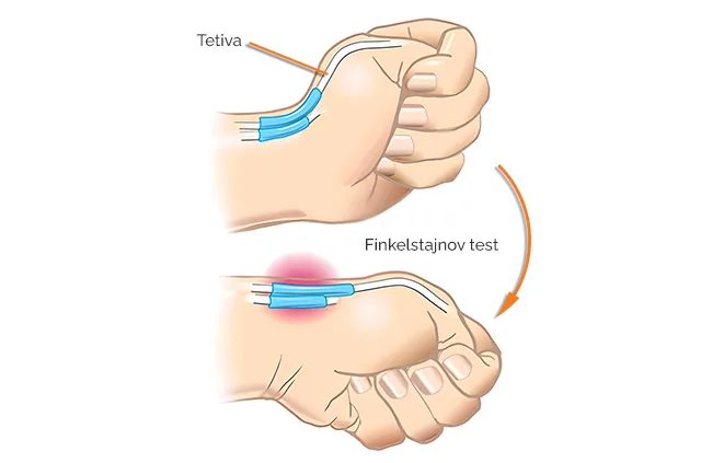 Finkelstajnov test