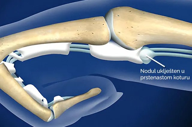 Škljocavi prst, nodul uklješten u prstenastom koturu
